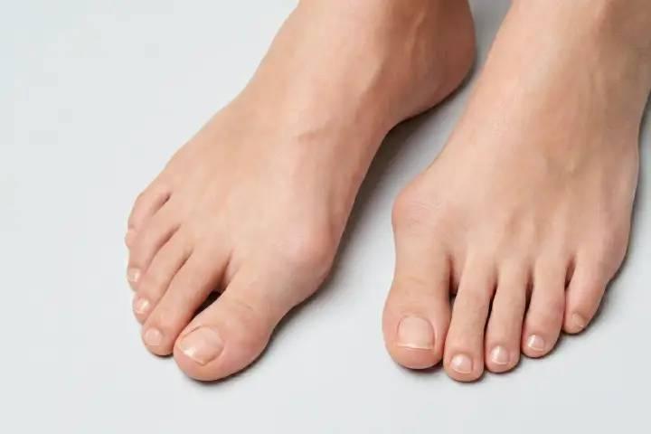 親指の付け根が痛い…それ外反母趾かも?代表的な症状を解説